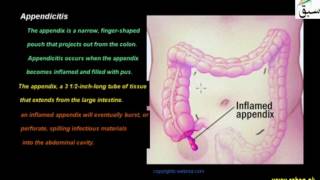 Appendicitis
