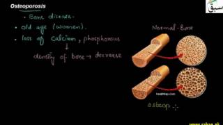 Osteoporosis