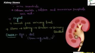 Kidney Stones