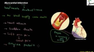 Myocardial Infarction