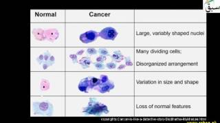 Cancer (Uncontrolled Cell Division)