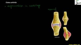 Arthritis and its Types
