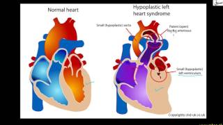 Congenital Heart Problems