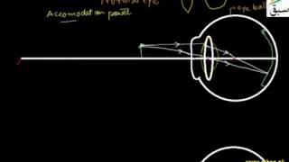 Farsightedness