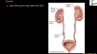 Kidney Stone