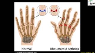 Arthritis and its Types