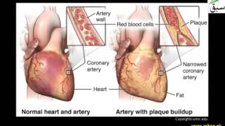 Angina Pectoris