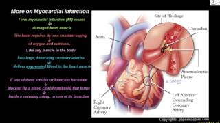 More on Myocardial Infarction
