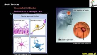 Brain Tumors