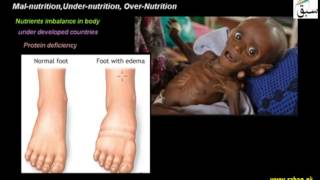 Mal-nutrition,Under-nutrition, Over-Nutrition