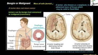 Bengin or Malignant