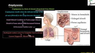 Emphysema