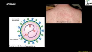 Measles