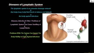Diseases of Lymphatic System