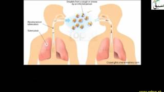 Pulmonary Tuberculosis (T.B)