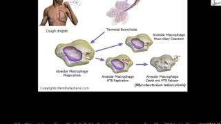 Pulmonary Tuberculosis  (T.B)