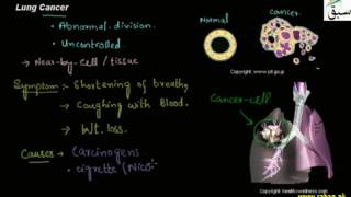 Lung Cancer