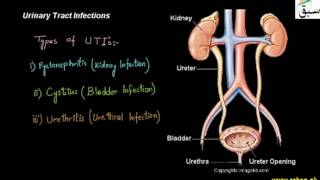 Urinary Tract Infections (UTIs)