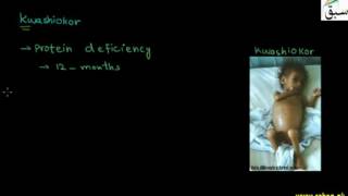 Protein-Energy Malnutrition