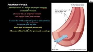 Arteriolosclerosis