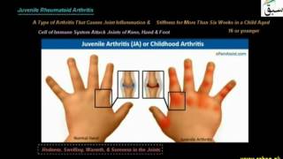 Autoimmune Disease