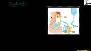Kidney (Renal) Failure, Dialysis