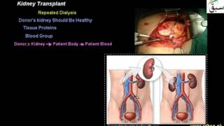 Kidney Transplant