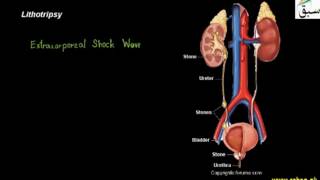Removal of Kidney Stone