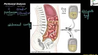 Peritoneal Dialysis
