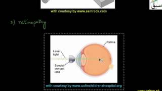 More on Kinds of Lasers