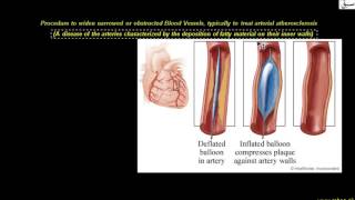 Angioplasty