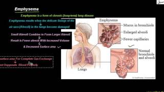Emphysema