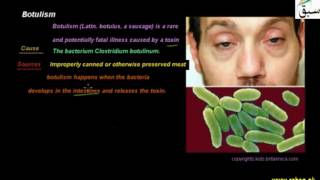 Botulism