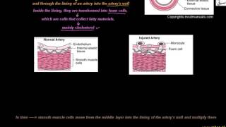 More on Atherosclerosis