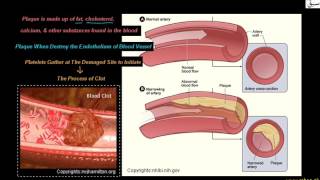 Thrombosis