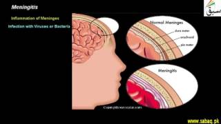 Meningitis