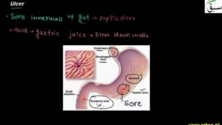 Constipation, Ulcer
